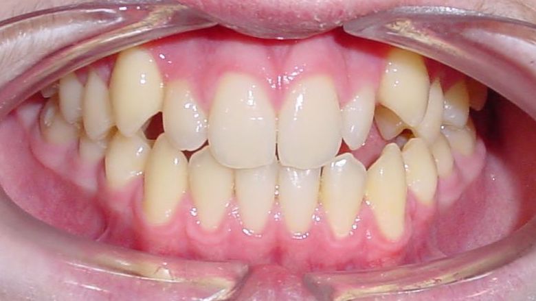 Zähne vorstehende Vorstehende Zähne