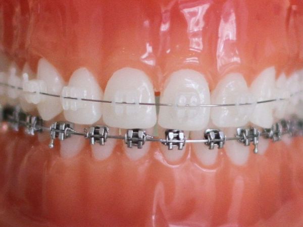 Keramikbrackets im Oberkiefer