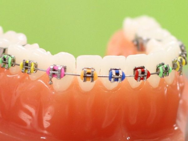 Metallbrackets mit Alastics