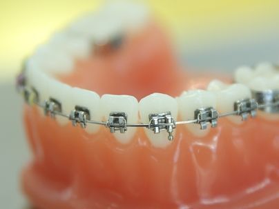 Metallbrackets mit Drahtligaturen