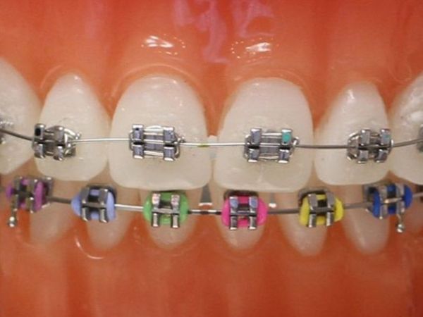 Normale Metallbrackets