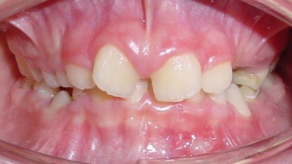 Diastema - Lücke zwischen oberen Schneidezähnen