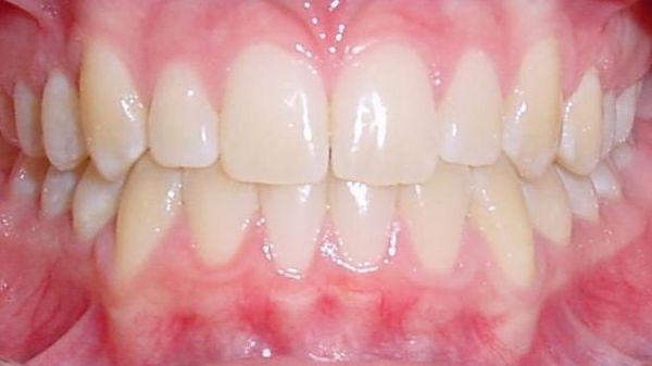 Retainer unsichtbar im Mund