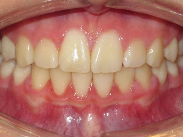 4. Ende der Behandlung, tiefer Biss ist behoben