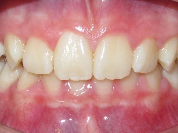 1. Patientin würde sich Brackets im Unterkiefer abbeißen