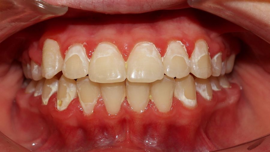 Entkalkungen im Bereich um die Brackets nach fester Zahnspange bei schlechter Zahnpflege