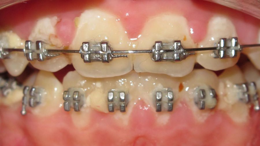 Dicke Speisereste und Zahnbeläge zwischen Brackets und Drähten
