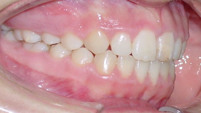 Zähne der Patientin Nr. 6 nach der kieferorthopädischen Behandlung