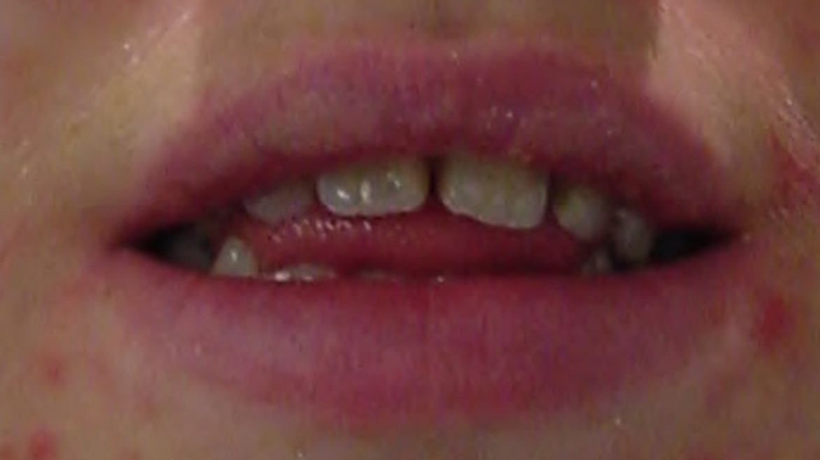 Infantiles Schluckmuster, Zunge presst beim Schlucken zwischen die Zähne