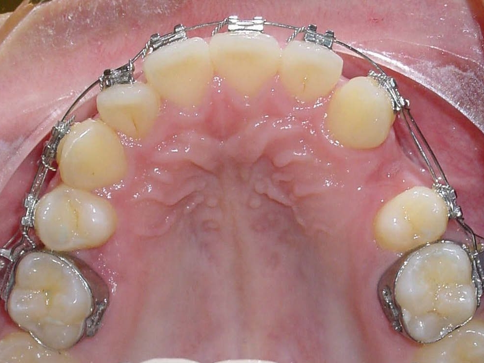 Kleiner Backenzahn und Zahn auf der Gegenseite wurden entfernt, damit Zahnbogen symmetrisch werden kann (Patient Nr. 36)
