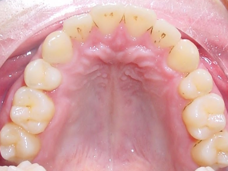 Zahnlücke kieferorthopädisch geschlossen