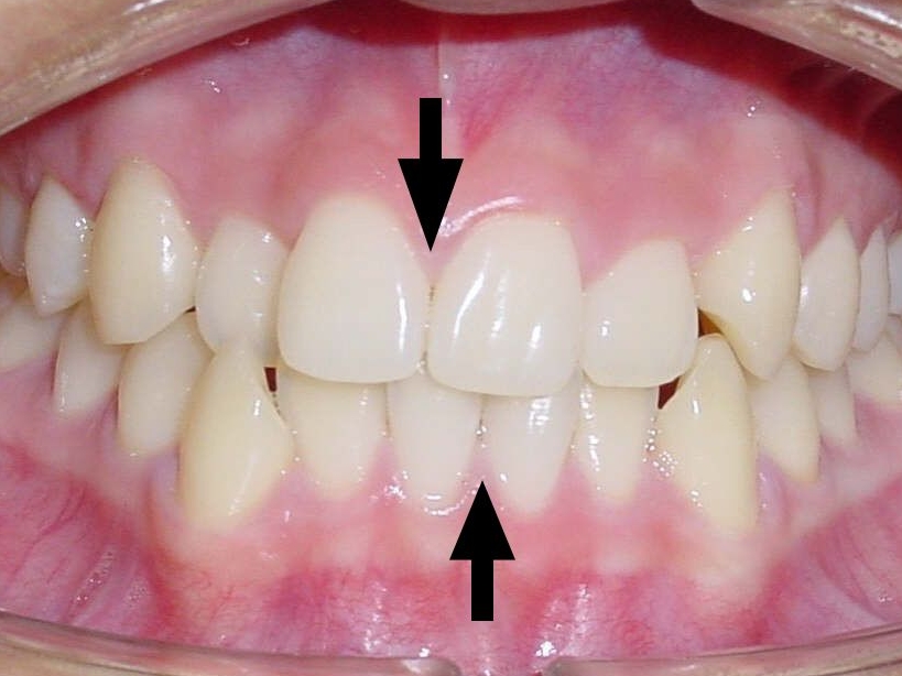 Starke Mittenabweichung der Zähne im Oberkiefer nach rechts