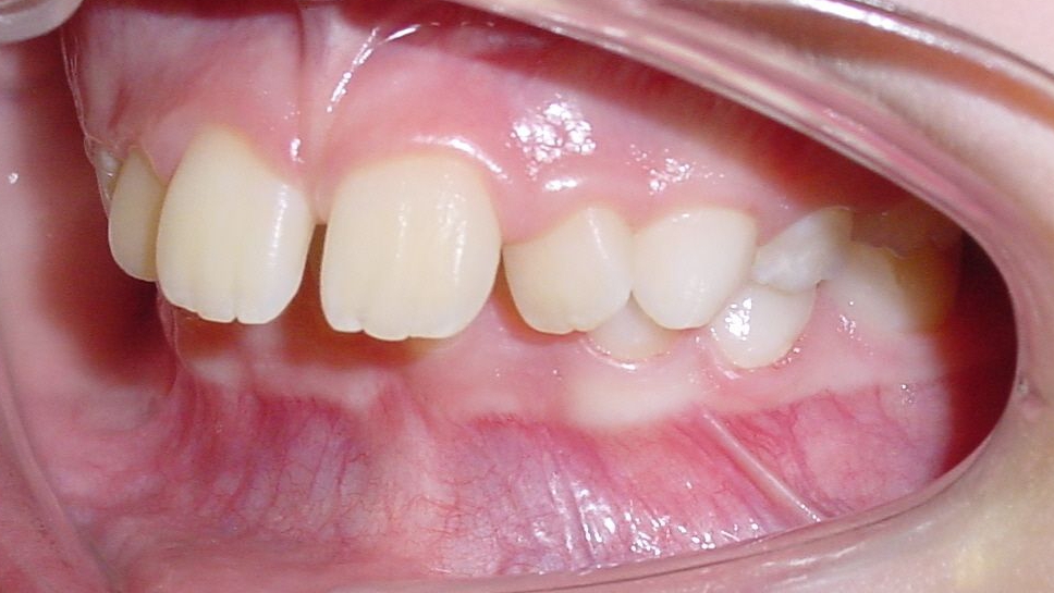Vorstehende zähne