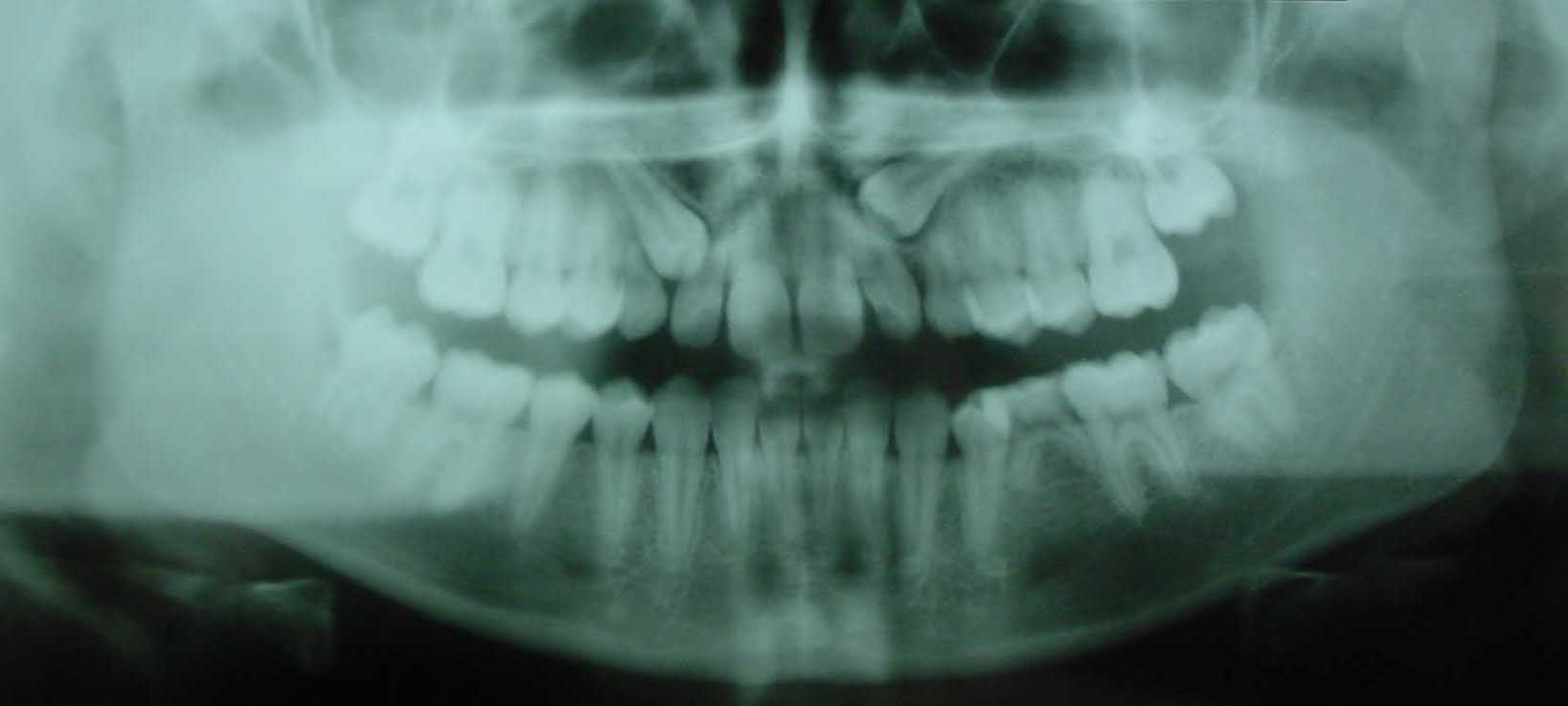 Verlagerung der oberen Eckzähne und Nichtanlage eines kleinen Backenzahnes (Zahn 35)