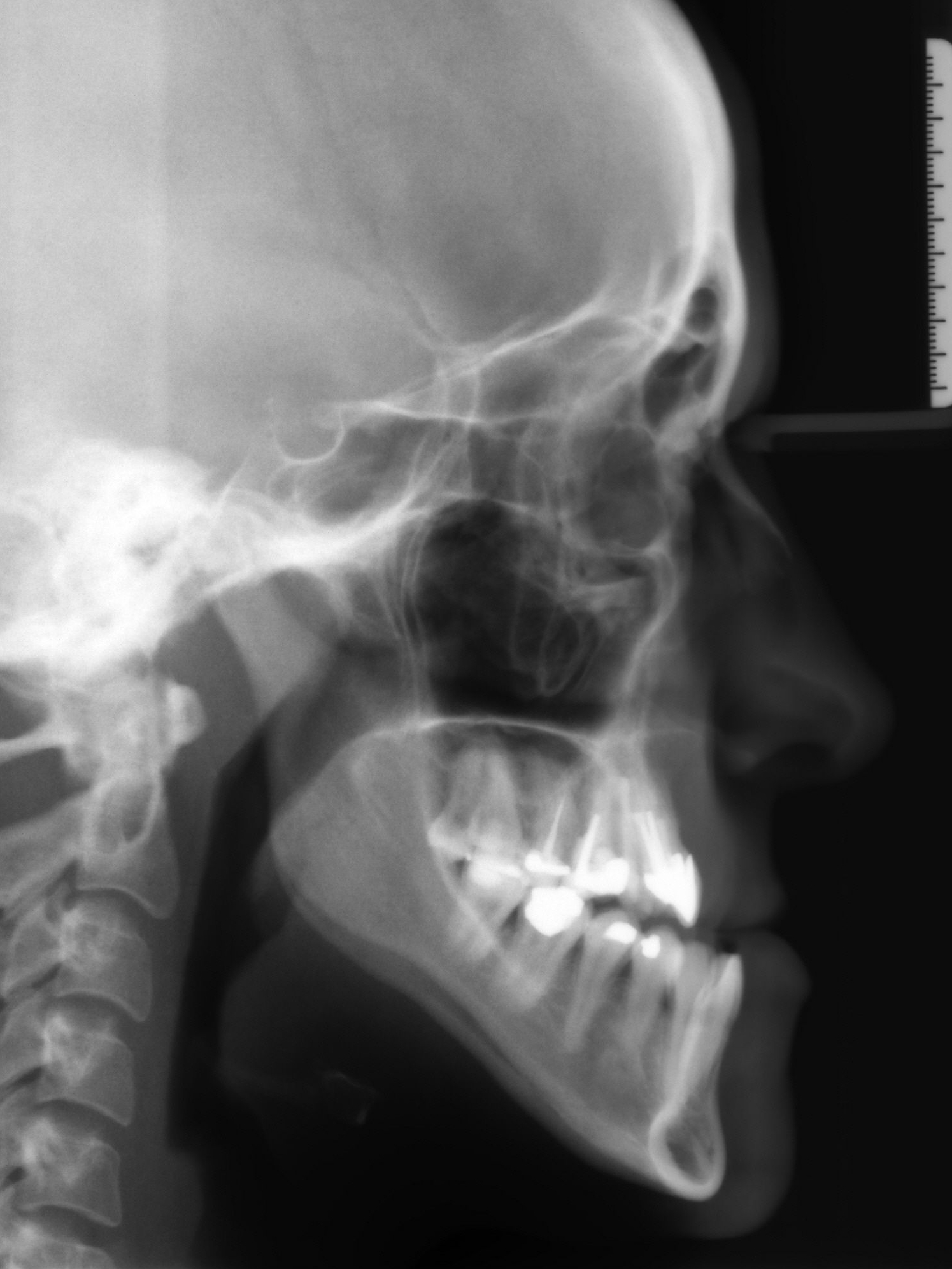 Fernröntgenseitenbild mit starker Unterkiefervorlage
