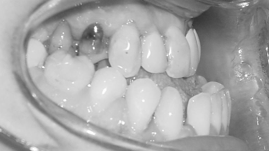 Untere Zähne stehen stark vor