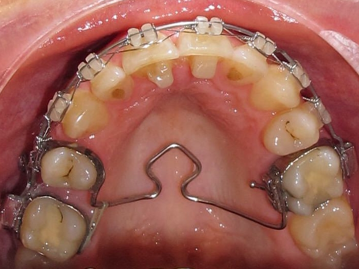 Lückenschluss unter Stabilisierung der vorderen Zähne