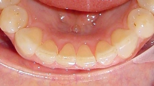 Zähne nach der Behandlung mit Alignern von Invisalign