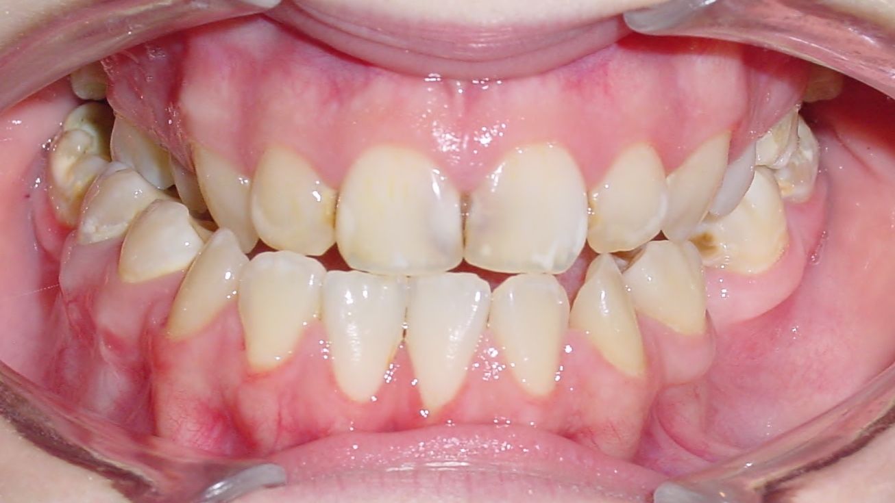 Zähne der Patientin Nr. 99: Kreuzbiss auf dem Foto links