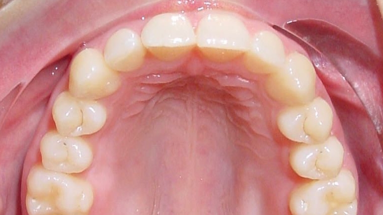 Zähne nach der Behandlung mit Invisalign