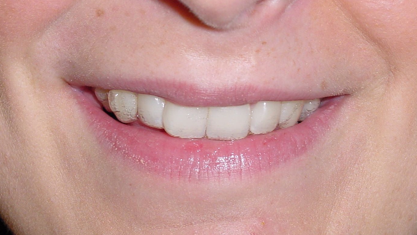 Lächelnde Patientin mit Aligner von Invisalign im Mund