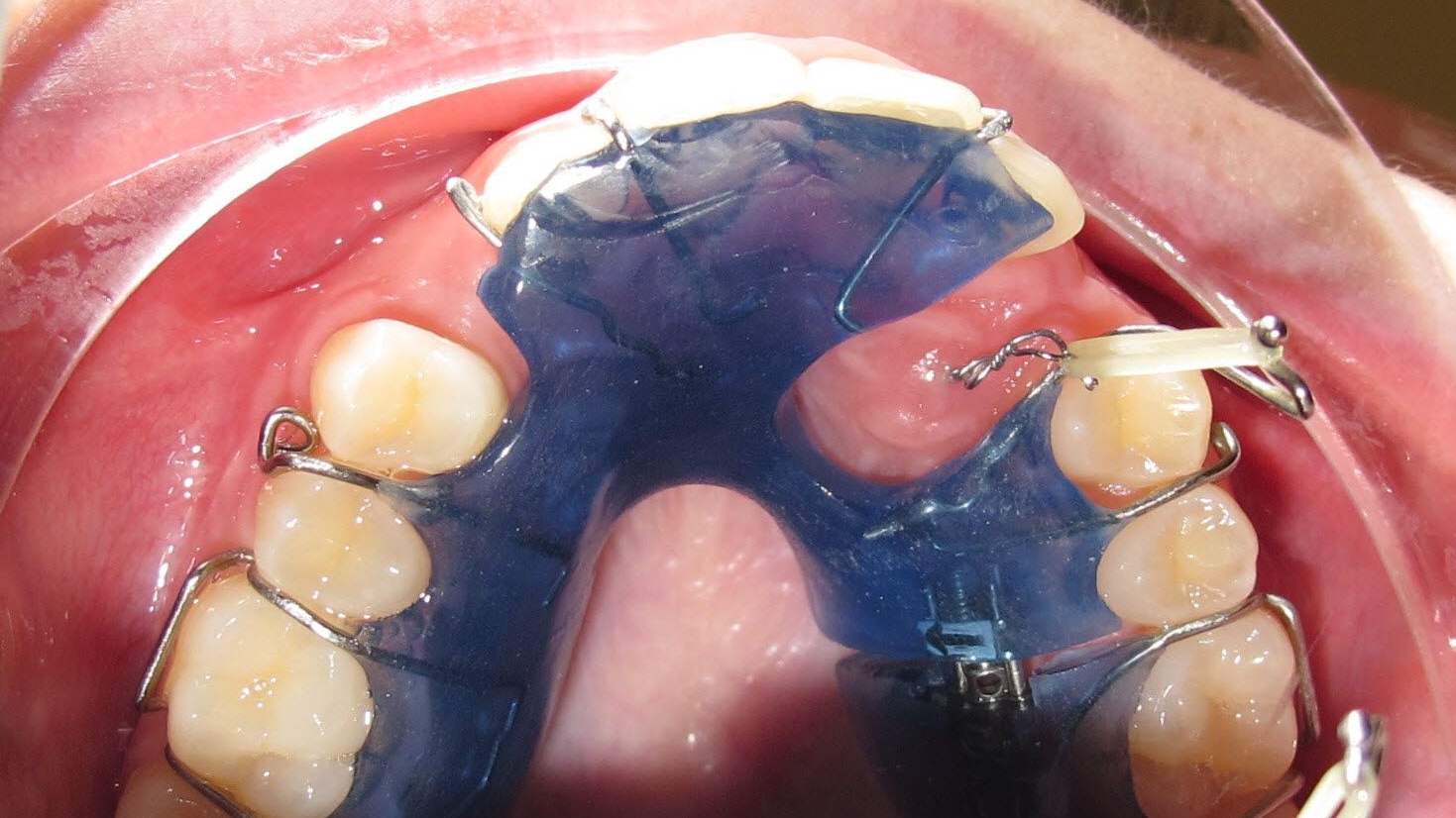 Einzelplatte mit Freilegungshaken. Patientin zieht den Eckzahn mit einem Gummiring an der Drahtschlaufe in die Zahnreihe.