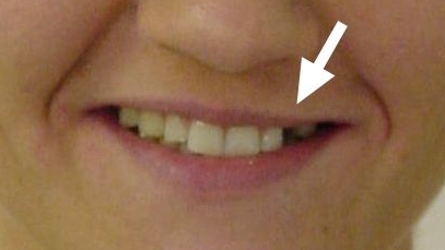 Vorher: Optisch scheint der Patientin ein Zahn zu fehlen.