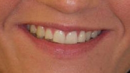 nachher: Eckzahn ist eingeordnet und die augenscheinliche Zahnlücke verschwunden